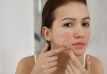 Trądzik zaskórnikowy – jak go leczyć?