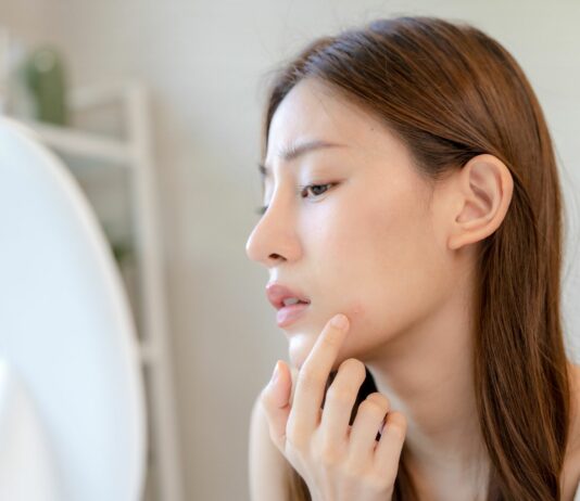 Wakacyjny trądzik: czy SPF-y naprawdę zapychają? I co z tym zrobić?