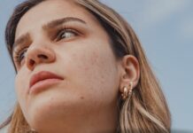 Sekrety skóry bez trądziku po 25. roku życia