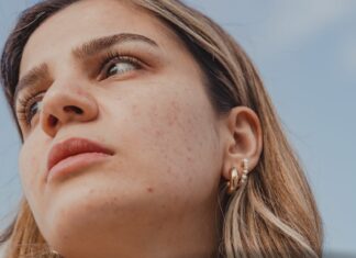 Sekrety skóry bez trądziku po 25. roku życia