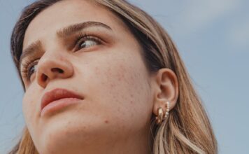 Sekrety skóry bez trądziku po 25. roku życia