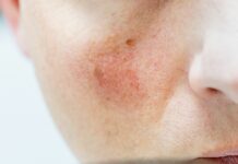 Pękające naczynka – co im szkodzi, a co naprawdę wzmacnia ścianki żył?