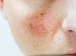 Pękające naczynka – co im szkodzi, a co naprawdę wzmacnia ścianki żył?