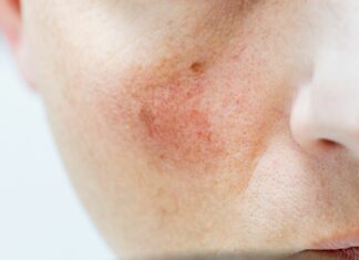 Pękające naczynka – co im szkodzi, a co naprawdę wzmacnia ścianki żył?