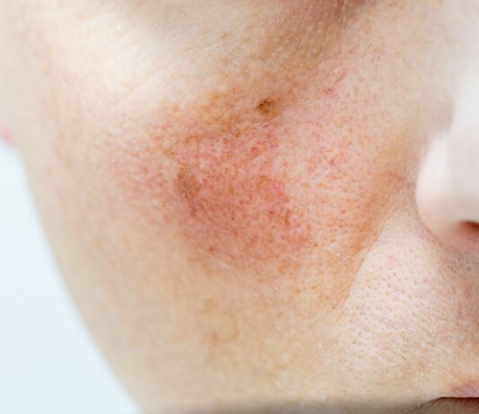 Pękające naczynka – co im szkodzi, a co naprawdę wzmacnia ścianki żył?