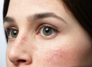 Rumień znikąd? 4 rzeczy, które go podbijają