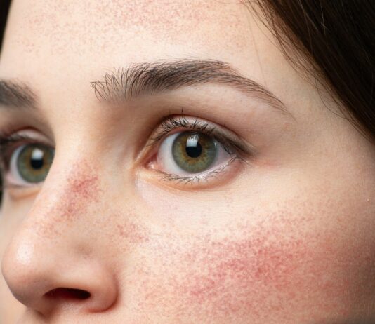 Rumień znikąd? 4 rzeczy, które go podbijają