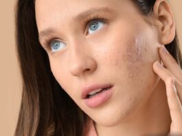 Jak stosować tretinoinę?