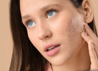 Jak stosować tretinoinę?