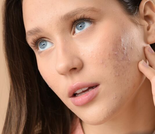 Jak stosować tretinoinę?