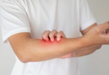 Egzema – dlaczego wraca i co naprawdę ją zaostrza