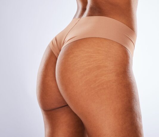 Poznaj skuteczne sposoby na pozbycie się rozstępów