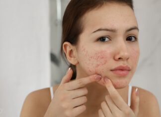 Trądzik zaskórnikowy – jak go leczyć?