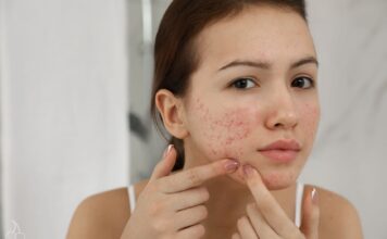 Trądzik zaskórnikowy – jak go leczyć?
