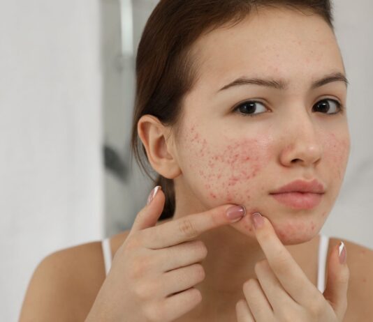 Trądzik zaskórnikowy – jak go leczyć?