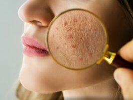 Pielęgnacja „stresowej skóry” – gdy za wypryskami stoi kortyzol, a nie krem