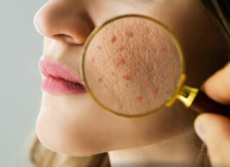 Pielęgnacja „stresowej skóry” – gdy za wypryskami stoi kortyzol, a nie krem