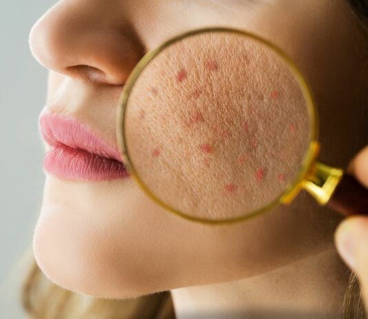 Pielęgnacja „stresowej skóry” – gdy za wypryskami stoi kortyzol, a nie krem