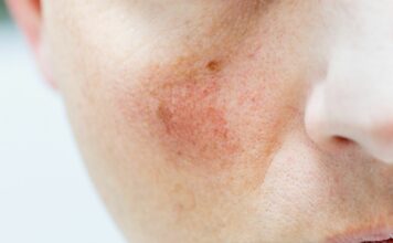 Pękające naczynka – co im szkodzi, a co naprawdę wzmacnia ścianki żył?