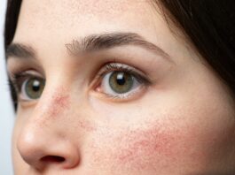 Rumień znikąd? 4 rzeczy, które go podbijają