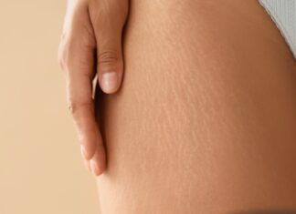 Stare vs świeże rozstępy – co działa na które?