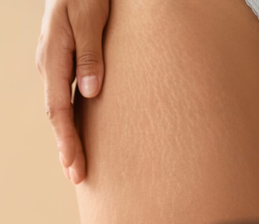 Stare vs świeże rozstępy – co działa na które?