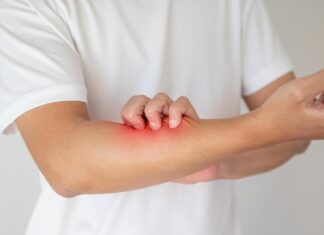 Egzema – dlaczego wraca i co naprawdę ją zaostrza