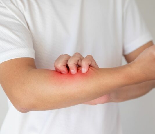 Egzema – dlaczego wraca i co naprawdę ją zaostrza